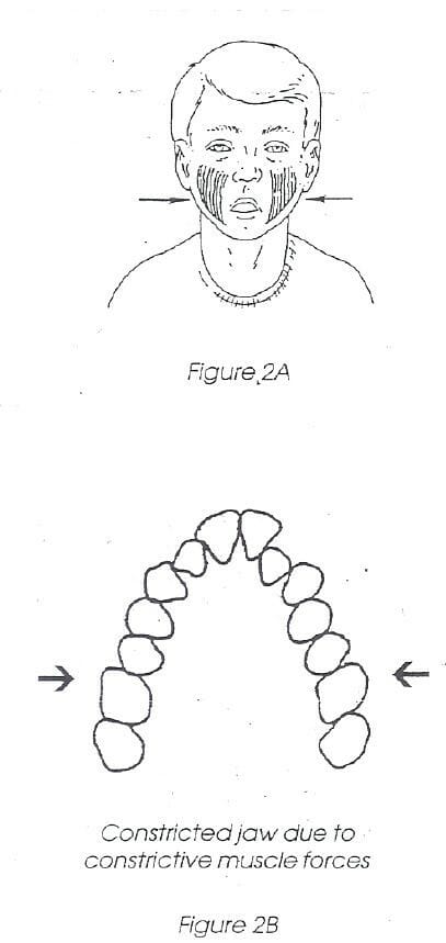 A drawing of a constricted jaw due to constrictive muscle forces