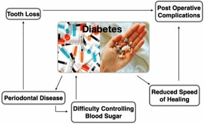 A flow chart showing how Diabetes can be related to tooth loss