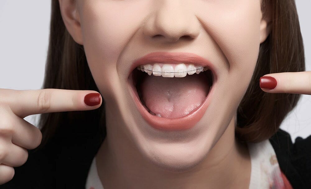 A woman pointing at her braces