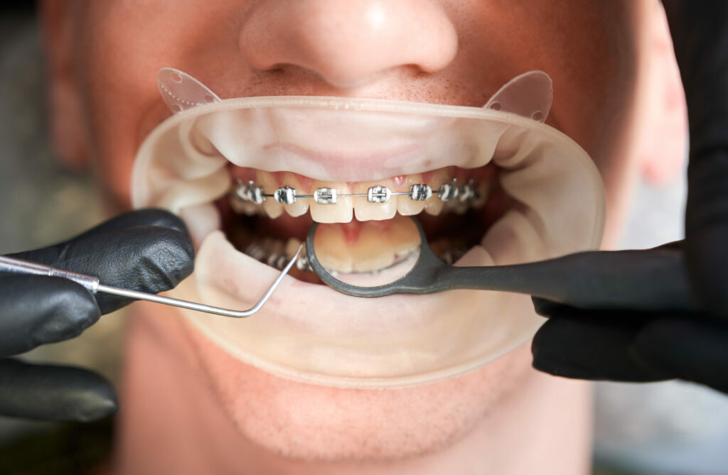 lingual braces