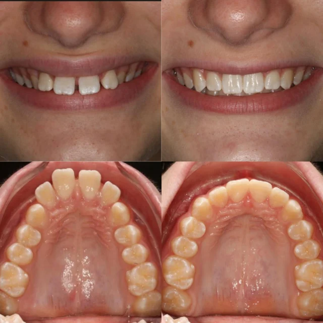 can tirzepatide cause teeth problems Ozempic and Oral Health: What You Need to Know